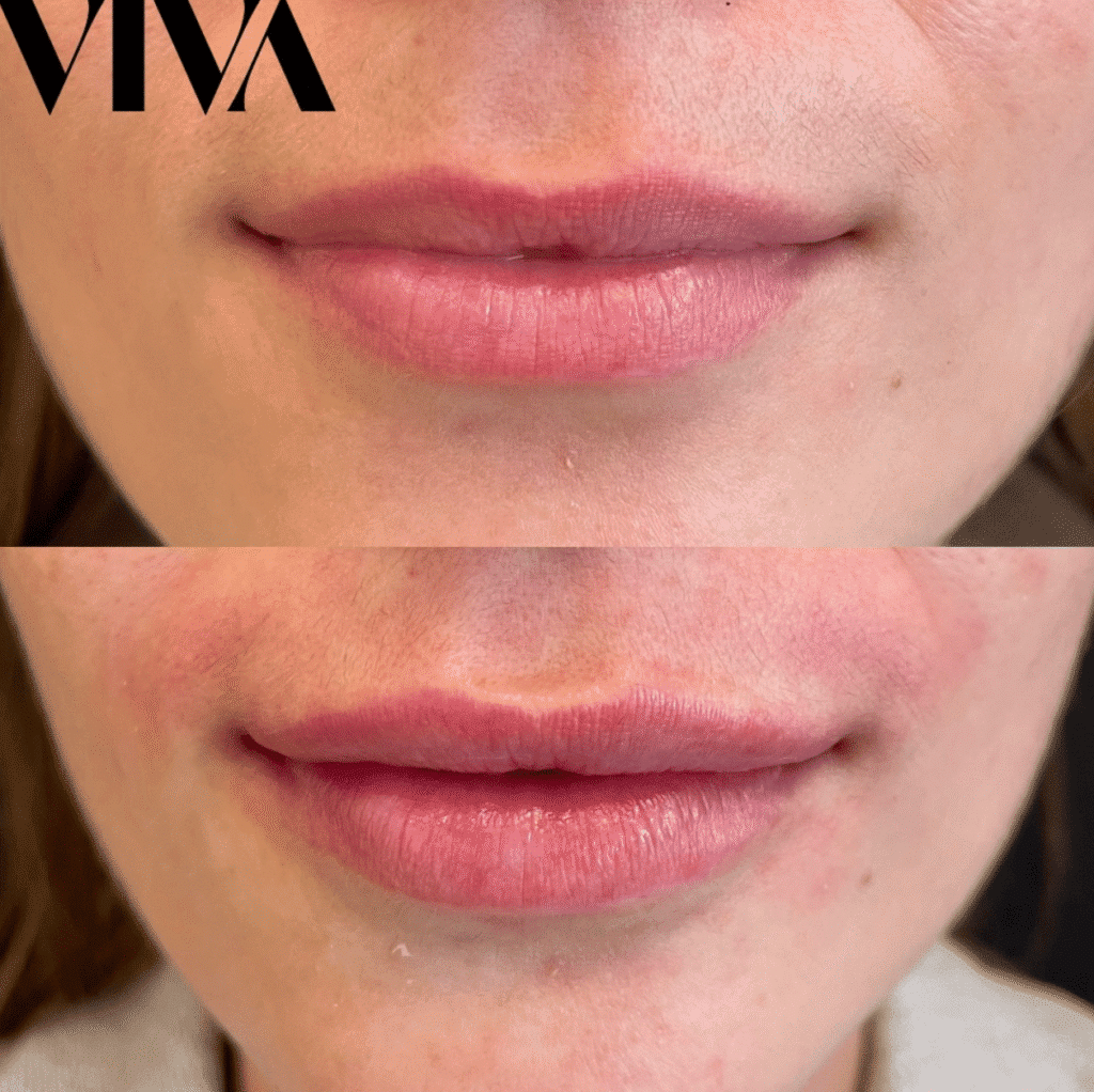 lip filler before after 3