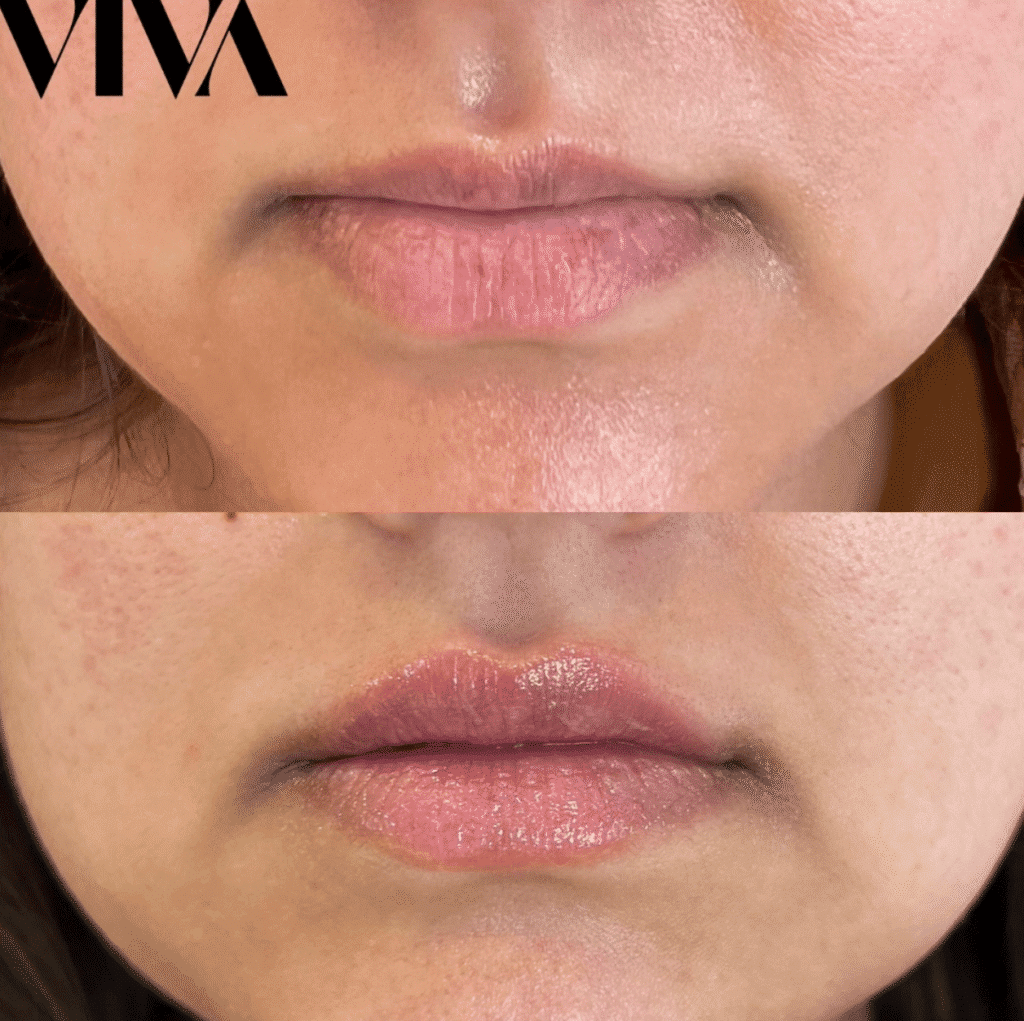 lip filler before after 4