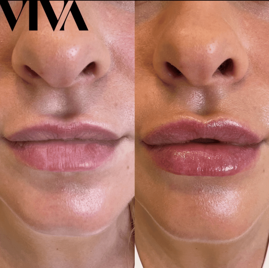 lip filler before after 5