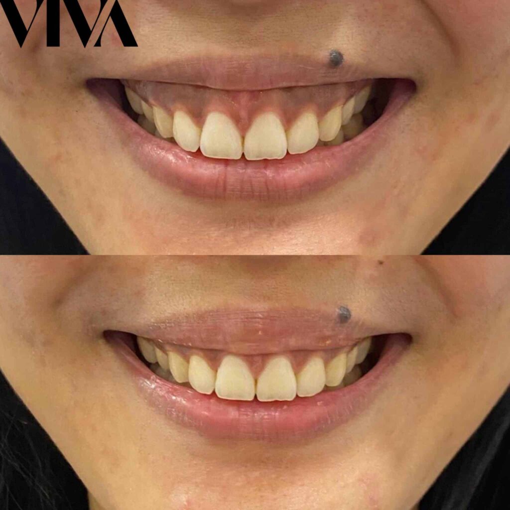 lucy before and after 2 scaled 1