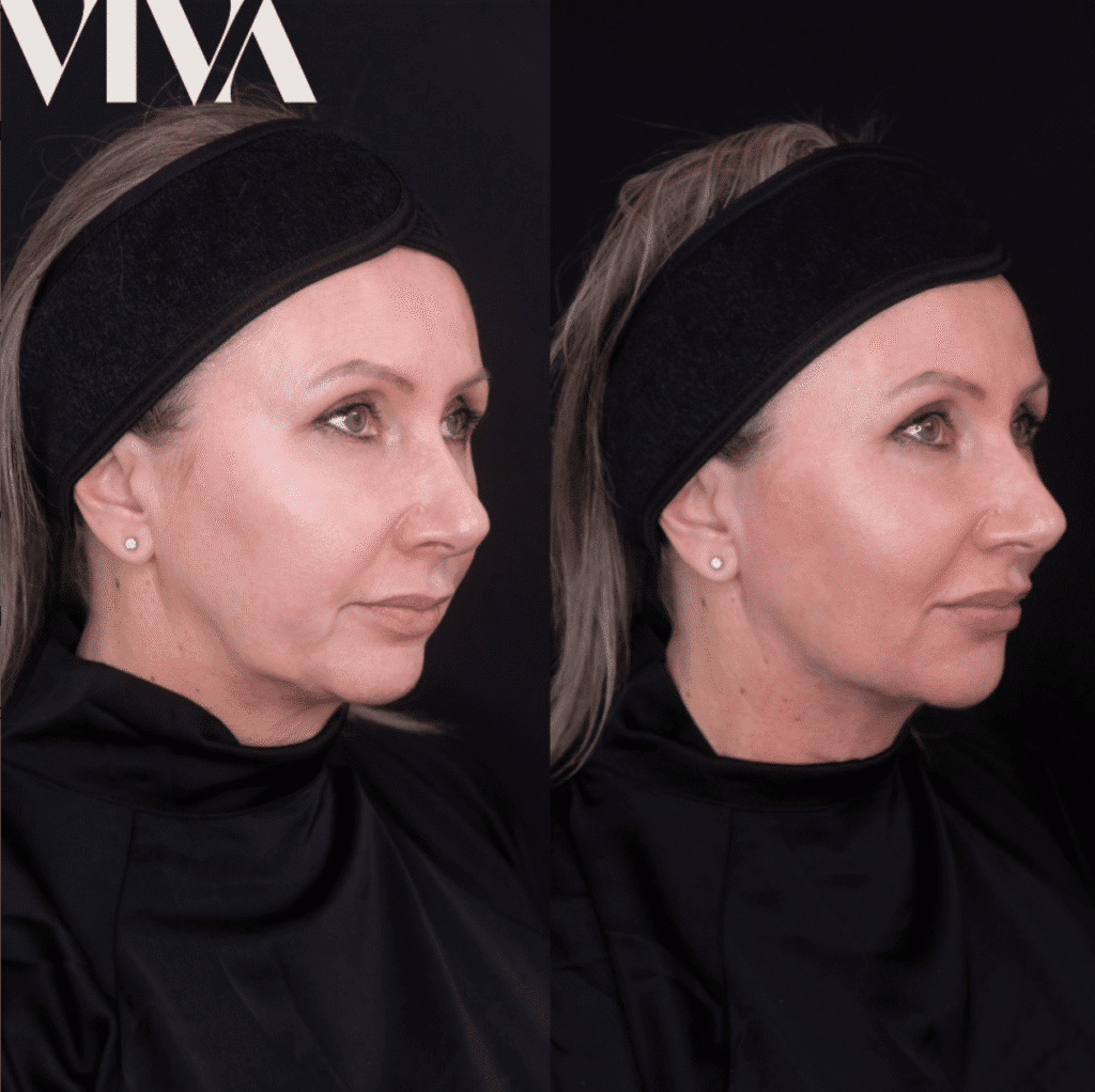 non surgical facelift