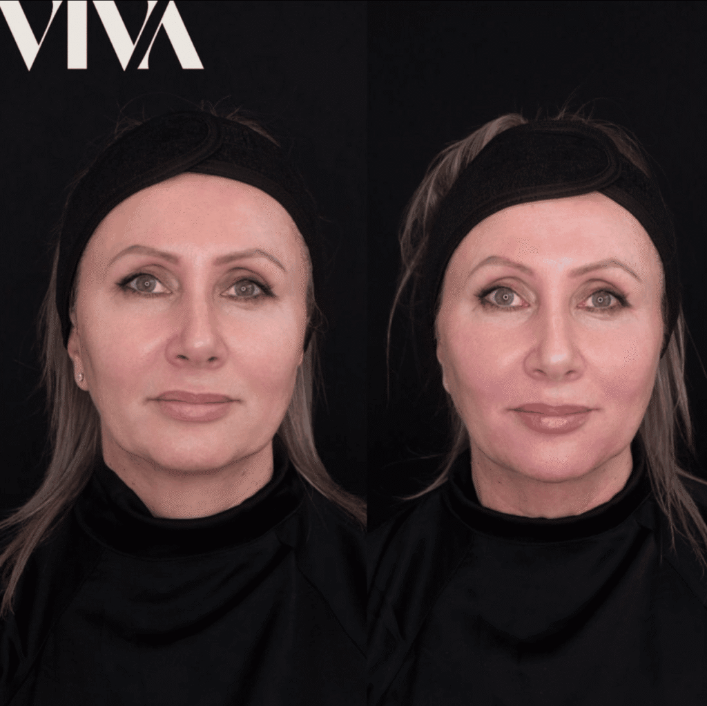 non surgical facelift 2