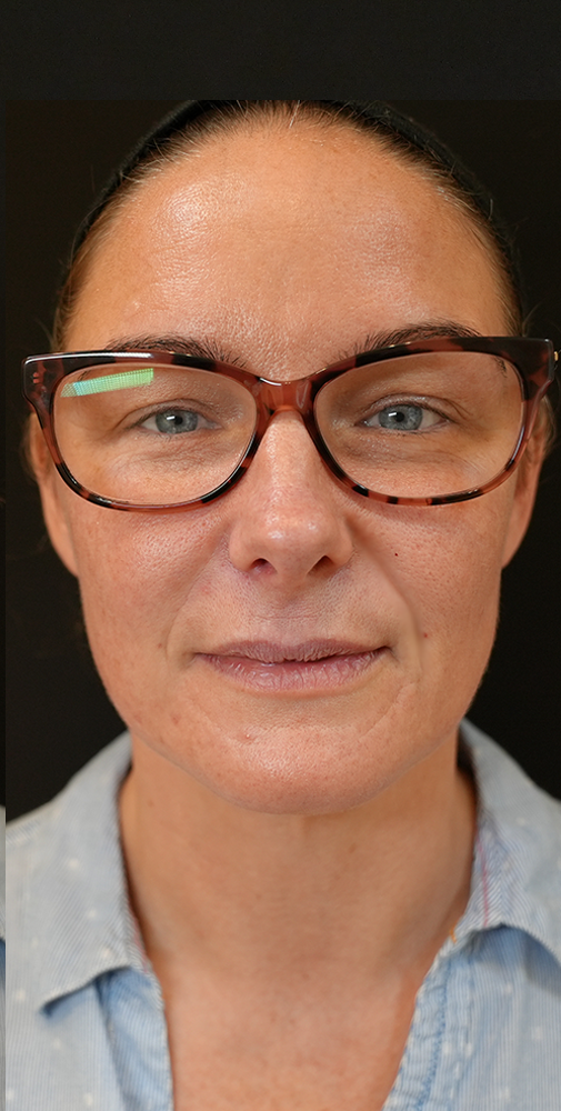 nose to mouth lines treatment with dermal filler after photo