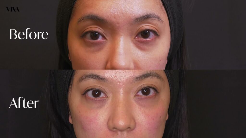 Does tear trough filler reduce wrinkles? 6 Tear Trough Filler